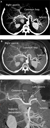 Figure 3 (A) Axial maximum intensity projection image at the level of the celiac artery. The common hepatic (hep.), splenic, and right gastric arteries are identified. (B) Axial “iodine-material” image at the level of the celiac artery. The common hepatic, splenic, and right gastric arteries are identified. (C) Coronal “iodine-material” image at the level of the celiac and superior mesenteric arteries. The common hepatic, left gastric, splenic, and superior mesenteric arteries are identified.