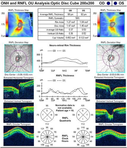 Figure 2 Average RNFL thickness is asymmetrical in both eyes with 58% of asymmetry. RNFL thickness values for different locations of the optic nerve scans showing the average thickness in μm in superior, temporal, inferior and nasal quadrants. The RNFL in the nasal quadrant of the right eye and left eye are 68 μm and 59 μm, respectively. Both readings are significantly thin compared with normal controls (96 μm). The RNFL in the temporal quadrant of the left eye is 55 μm which is severely thin compared with normal controls (73 μm). This thinning of RNFL quadrants is consistent with ON.
