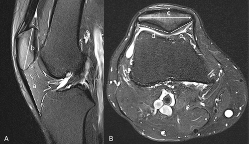 Figure 1 Patellar morphologic parameters. a: patellar ligament length, b: patellar height, c: patellar transverse diameter, d: lateral patellar facet, and e: medial patellar facet. (A) Midsagittal T2-weighted image. (B) Axial T2-weighted image.