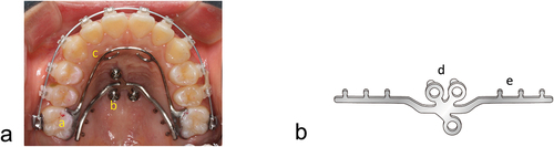 Figure 1. A palatal skeletal anchorage appliance.