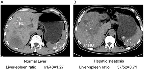 Figure 1 Measurement of hepatic steatosis using non-enhanced abdominal CT.Notes: Representative tomographic images showing the points for the measurement of attenuation and the obtained values. (A) Normal liver and (B) hepatic steatosis.
