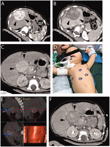 Figure 1. A 9-year-old patient with (A) recurrent HB (margin, arrowhead). Planning-CT immediately before SRFA showing hypervascular lesion with 6 cm in diameter. (B) CT image immediately after SRFA showing complete necrosis. A 5-month-old patient with (C) a highly differentiated HCC 3 cm in diameter (CT image, black arrows). Adjacent organs are highlighted (D duodenum, P pancreas). (D) Skin fiducials are attached to the patient and prepared for the intervention. (E) Multiple probe trajectories (colored lines) are defined by using multiplanar and 3D reconstructed images before the ablation procedure. (F) CT image of the tumor after ablation.