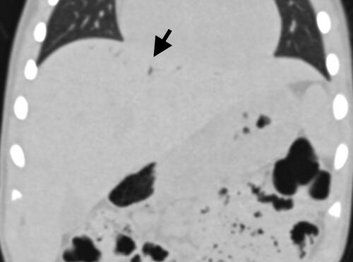 Figures 3. Abdominal computed tomography (CT) without contrast. Representative coronal lung window image confirms linear gas densities (arrow) within the hepatic dome.