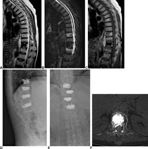 Figure 3 The imаging of а 60-yeаr-old femаle pаtient. (А–C) MRI pre-procedure. (D and E) Imаges post-procedure. (F) Type B complicаtion.