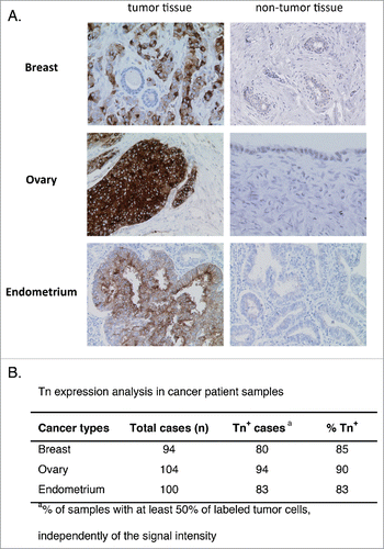 Figure 6. Analysis of Tn expression in cancer samples from patients. Breast, ovary, and endometrium tumor samples were analyzed by IHC. (A) Representative images of Tn expression in tumor and in healthy breast, ovary and endometrium tissues. (B) Quantification of Tn expression in the different tumor samples.