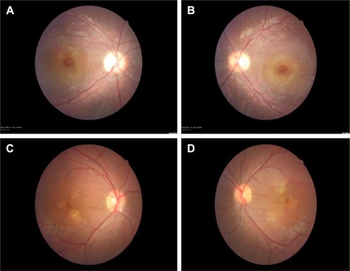 Figure 5 Represents the color fundus photos of the right and left eyes.