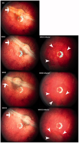 Figure 3. Images of the fundus and injected particles. The left column shows the optic nerve and visual streak. The right column displays the inferior view of the fundus. The injected particles appeared reddish due to the color of DNR (arrows) and aggregated into the inferior vitreous cavity (arrow heads) within a few days after the injection. Fundus photographs at all-time points showed clear vitreous and normal retina.