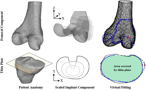 Figure 1. The subject anatomy (left), scaled implant components (middle), and virtual fitting (right) is shown for the femur (top row) and the tibia (bottom row). Red dots on the right images show the location of the maximum OUH. Yellow plane illustrates the tibia bone resection plane.