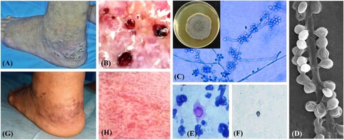 Figure 1. (A) Plaques with crusting on left heel at initial visit. (B) Dermoscopy of the lesion exhibited irregular blackish-red dots. (C) Tan velvety colonies on SDA medium and the microscopy (×400) of the slide culture at 28°C. (D) SEM showed oval conidia around hyphae in a sleeve-like arrangement (×10,000). (E) Oval dark red yeast coloured by PAS stain (×1000). (F) Black yeast by GSM stain (×400). (G) Healed heel after anti-fungal treatment. (H) Dermoscopy of healed heel showing no more blackish-red dots.