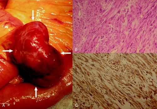 Figure 2.  The lesion located in the right abdominal cavity attached to the jejunum wall, growing in an extraluminal manner (A). Microscopically, the tumor was composed of fascicles of spindle cells in an edematous background (hematoxylin and eosin stained, ×200) (B), which were positive for CD117 (diaminobenzidine reaction, hematoxylin counterstain, ×200) (C).