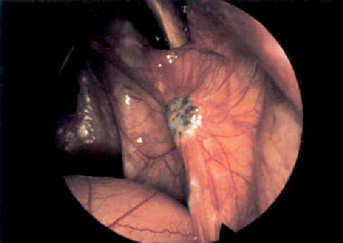 Figure 3. Black endometriosis.Reprinted from Citation[122].