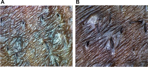 Figure 1 Penetration of sharptipped hairs into the skin (A) and multiple extrafollicular penetration with papules (B).