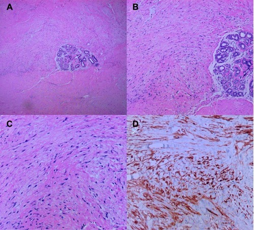 Figure 1 H&E staining and immunohistochemical staining of specimens in the case. (A) The mass was irregular and infiltrated the adjacent adipose tissue (magnification, x40). (B) the spindle cells were arranged in parallel and partially in a wavy configuration around the mammary duct (magnification, x100). (C) The spindle cells were poorly circumscribed with eosinophilic, pale cytoplasm, sparse nucleus chromatin, and unobvious nucleoli (magnification, x200). (D) Immunohistochemical stain for β-catenin showed nuclear positivity.