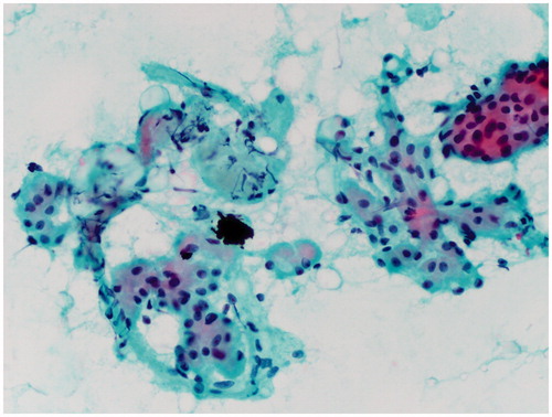 Figure 2. Photomicrograph showing clusters of oncocytic epithelium with associated adipocytes (Pap stain 400×).