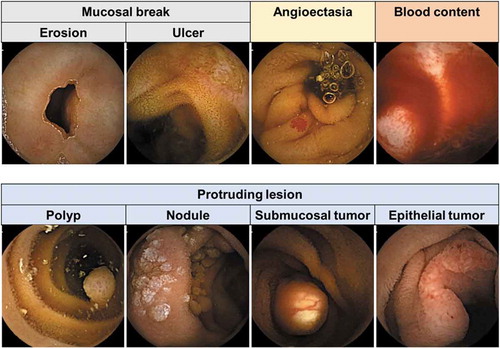 Figure 3. Representative images of various abnormalities captured by capsule endoscopy.