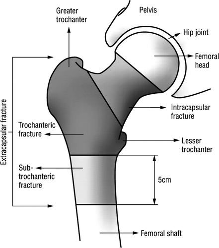 Figure 1. The hip joint and the proximal femur. Reprinted with permission from the BMJ.Citation[1]