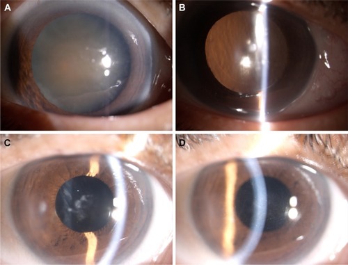 Figure 3 Preoperative grade 4 cataract (A). Slit lamp images taken immediately after operation (B), 2 weeks postoperatively (C), and 4 weeks postoperatively (D).