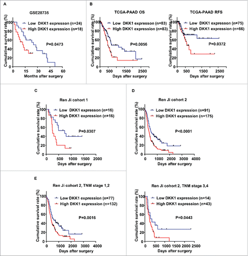 Figure 3. DKK-1 expression is associated with survival in PDAC patients. A. Kaplan-Meier survival curves demonstrated that patients with high expression of DKK-1 lived significantly shorter than those with low expression of DKK-1 in GSE28735. B. Data from TCGA-PAAD database showed that patients with high expression of DKK-1 had shorter OS and RFS than the patients in low DKK-1 group. C-D. In Ren Ji cohort 1 and 2, we defined the DKK-1 expression based on the results of qRT-PCR and IHC analysis, the Kaplan-Meier survival analysis suggested that high expression of DKK-1 is positive correlated with shorter OS in patients with PDAC. E. In Ren Ji cohort 2, we found that patients with high expression of DKK-1 lived shorter independent of TNM stage.