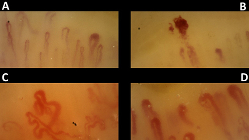 Figure 2 Nailfold Videocapillaroscopy in a healthy subject (A) compared with a patient with Mixed Connective Tissue Disease (B–D). The pattern is characterized by the presence of multiple Giant Capillaries and neoangiogenesis.
