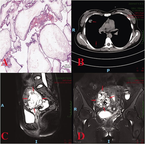 Figure 1. (A) A hydatidiform mole in the first case: villus edema, mild hyperplasia of trophoblastic tissue; (B) the metastatic tumors in the lung (indicate by the arrows); (C, D) a heterogeneous intramural mass on the right lateral wall of the uterus.