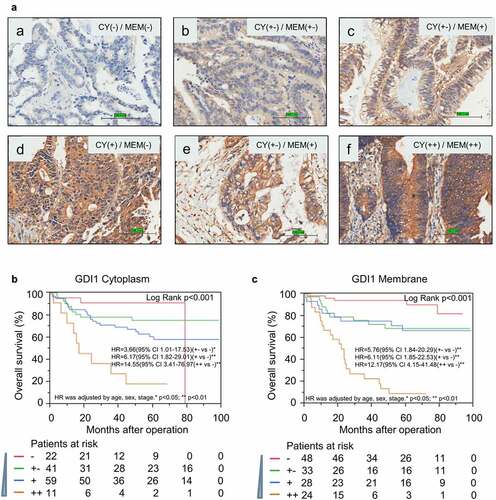 Figure 3. Immunohistochemistry analysis for the protein expression of GDI1 in the cytoplasm and membrane