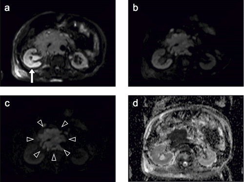 Figure 3. (A) Diffusion-weighted image (DWI) with a b value of 50 s/mm2 showing the right kidney (arrow) as a high signal intensity area more clearly than a T2-weighted image. (B) DWI with a b value of 500 s/mm2. (C) DWI with a b value of 1000 s/mm2 (high b value DWI). As the b value increased, the signal intensity of the kidney decreased bilaterally, whereas that of the retroperitoneal tumor was relatively well preserved. The retroperitoneal tumor in demarcated from the surrounding organs (arrowheads), clearly highlighted by a high b value. (D) An apparent diffusion coefficient (ADC) map shows that the signal intensity is lower in the right kidney than in the left kidney and is very low in the retroperitoneal tumor. The ADC of the right cortex (1.85) was significantly lower than that of left cortex (2.49), and that of the retroperitoneal tumor was the lowest (0.68).