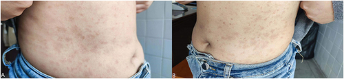 Figure 2 (A and B) After treatment of 2 days.