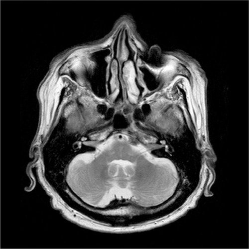 Figure 1 A left peripontine meningioma causing recurrent isolated sixth nerve palsies.