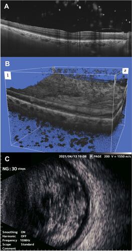 Figure 2 Asteroid hyalosis is seen as numerous hyperreflective foci in the vitreous in cross-sectional optical coherence tomography (OCT) scans (A) as well as 3D OCT (B), and as small round hyperechoic elements in the vitreous in B-scan ultrasonography (C).