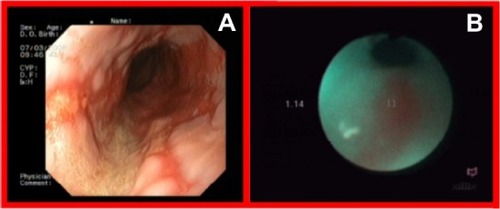 Figure 6 Esophageal tumor in white light endoscopy (A) and autofluorescence (B) imaging.