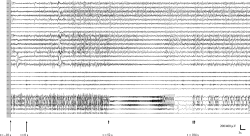 Figure 1 Recording of v-EEG during administration of etomidate and the subsequent seizure observed. Discontinuous arrow marks the end of etomidate infusion. Continuous arrow shows the 99mTc-HmPAO infusion. Arrowhead indicates the start of seizure and double arrowhead marks the end of it.