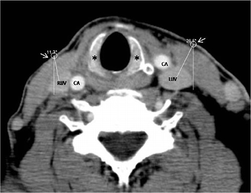 Figure 1.  Axial CT image shows the automatically calculated angles between the clinical entry point (arrows) and the center of the IJVs at the cross-sectional level of the cricoid cartilage (*). CA, carotid artery; RIJV, right internal jugular vein; LIJV, left internal jugular vein.