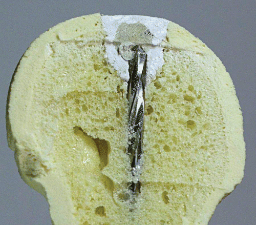Figure 5. Section through a proximal femur after drilling with the drill left in situ. [Color version available online.]