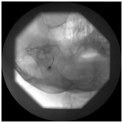 Figure 1 Left oblique submental fluoroscopic view showing needle directed toward the foramen ovale.