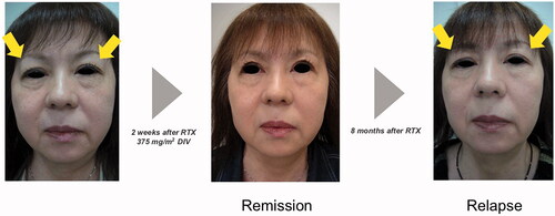 Figure 2. The changes in facial appearance of the patient with immunoglobulin G4-related dacryoadenitis. Rituximab rapidly improved the swollen upper eyelids and reduced the steroid levels, but the cases presented relapse within 3 years.