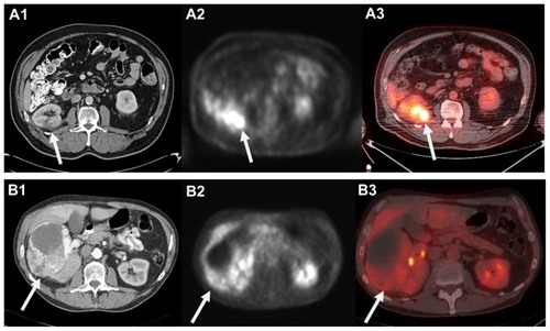 Figure 1 Computed tomography (CT) appearance of small right posterior renal tumor (A1) and corresponding 18F-fluoro-d-glucose positron emission tomography (18F-FDG-PET) (A2) and fused PET low-dose noncontrast CT (A3) images demonstrating FDG uptake. Please note mild right renal uptake related to tracer excretion in the collecting system. In contrast, a 12.5 cm anterior right renal mass clearly visualized on contrast-enhanced CT (B1) that demonstrated minimal to no FDG uptake and was falsely considered benign on PET and fused images (B2 and B3).
