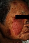 Figure 8 An 80-year-old female patient with pemphigus erythematosus presented with a 3-month history of erythematous and scaly, erosive patches along the seborrheic areas, aggravated by sun exposure.