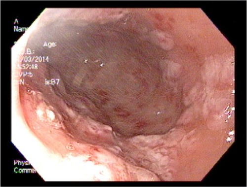 Figure 6 Upper endoscopy immediately after cauterization with the gold probe hemostasis catheter.
