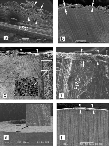Figure 2. SEM photomicrographs showing the surface of the SPF implant and the control implant, (a) Ideal surface porosity (between arrows) on SPF implant with unidirectional fiber-reinforced stem. (b) Variable surface quality of porosity (arrows) on SPF implant. (c) Porosity in the intramedullary canal of SPF implant with higher magnification (x250) detail. (d) Ideal porosity layer at the end of SPF implant (between arrows). (e) Control (PMMA) implants: filed end and higher magnification detail. (f) Side of control implant with slightly uneven filed surface (arrowheads).
