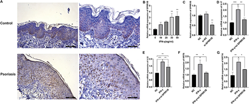 Figure 10 Biological experiments verify the relationship between SPRR1B and psoriasis. (A) Immunohistochemical analysis of SPRR1B expression in psoriasis patients and healthy controls. (B) Expression of SPRR1B in Hacat cells treated with IFN-γ (C) Expression of SPRR1B after HaCat cells were transfected with si-SPRR1B (D–G) Expression of IL17, IL22, KRT6, KRT16 in HaCat cells. Data are expressed as mean ± SD. *P < 0.05; **P < 0.01; ***P < 0.001.