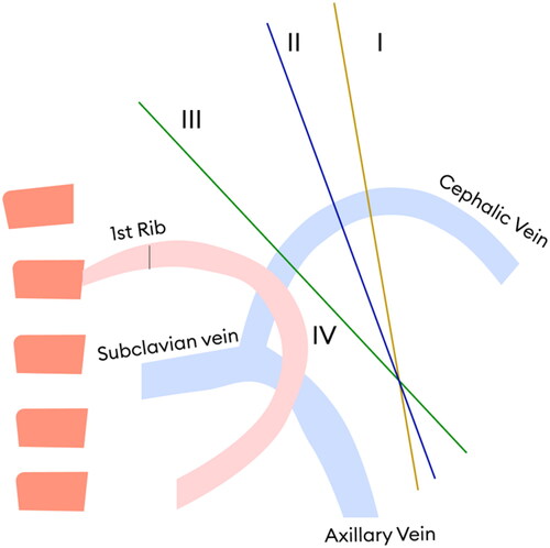 Figure 3. Anatomy of the Cephalic arch.