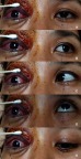 Figure 4 Day 7 limitation of extraocular movement of the right eye in (A) primary position, (B) left gaze, (C) right gaze, (D) up gaze, and (E) down gaze are demonstrated.