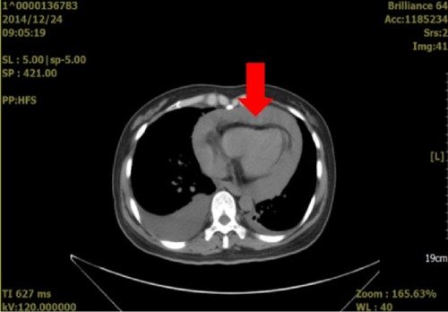 Figure 1 Computed tomography scan obtained on December 24, 2014 (7 days before treatment).