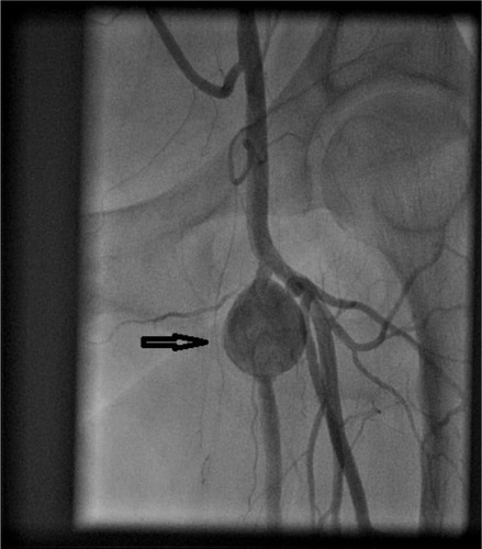 Figure 4 Angiogram showing pseudoaneurysm (arrow) formation in proximal left superficial femoral artery.