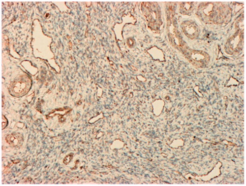 Figure 3. Immunohistochemistry analysis of VEGF Expression in the walls of venous vessels in areas of myometrium remodeling in patients with adenomyosis. IHC MAT to VEGF, original magnification 80×.