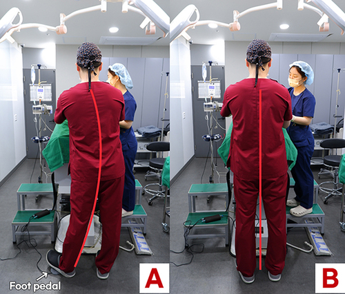 Figure 7 Comparison of surgeon’s posture when using a foot pedal versus the fingertip touch sensor. With the traditional foot pedal switch (A; left), the surgeon stands on one foot inducing a non-ergonomic and uncomfortable posture. Using the fingertip touch sensor (B; right) disperses the surgeon’s weight and provides an ergonomic and more comfortable posture. Adapted from. Park JH, Kim NR, Manonukul K. Ergonomics in follicular unit excision surgery. J Cosmet Dermatol. 2022;21:2146–2152. © 2021 The Authors. Journal of Cosmetic Dermatology published by Wiley Periodicals LLC. Creative Commons.Citation11