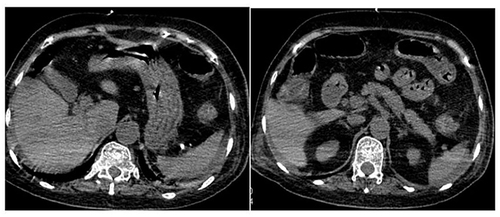 Figure 4 Abdominal CT showed intestinal wall edema and ascites.