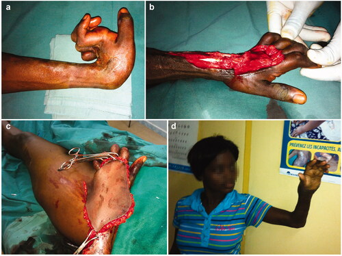 Figure 5. A case of severe hyperextension (a) that was treated by release (b) and ilionguinal flap for coverage of the defect(c). A postoperatory view (d).