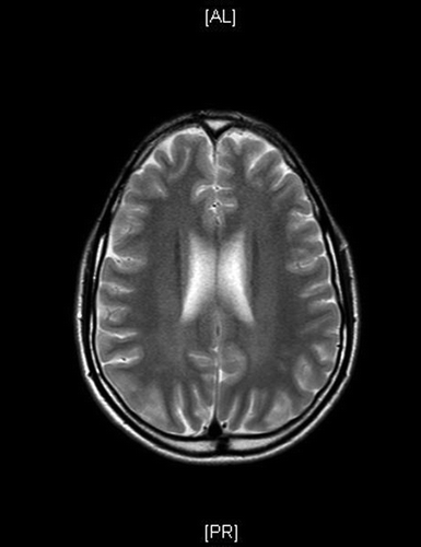 Figure 1: Magnetic resonance image of the brain of Patient 4