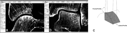 Figure 1. Preoperative planning of the talar defect and creation of a 3D graft model.